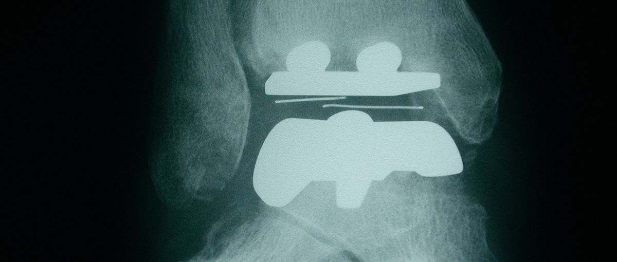 Total ankle replacement
