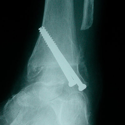 Ankle fusion