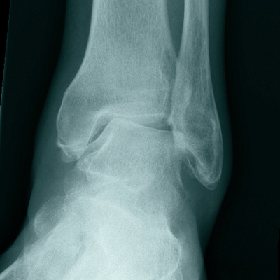 Ankle ligament injury