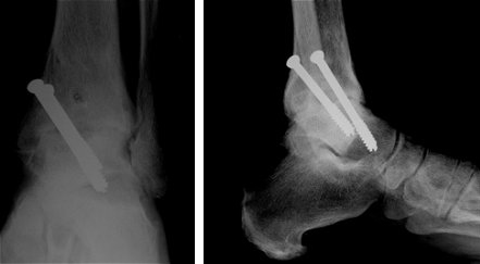 X-ray of ankle arthritis