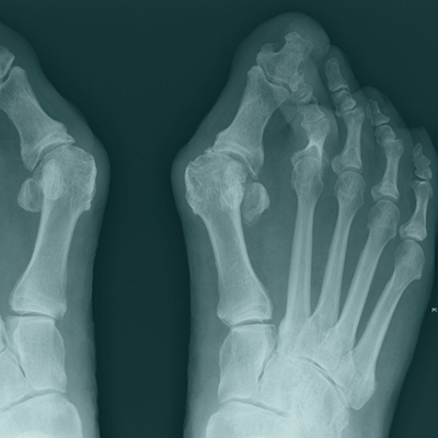 X-ray after osteotomy