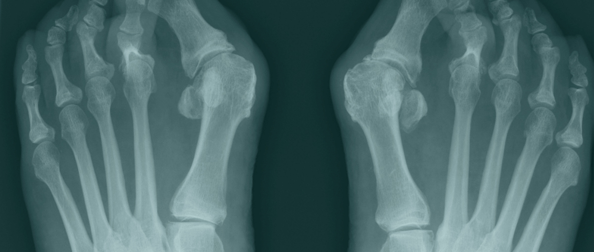X-ray of bunions