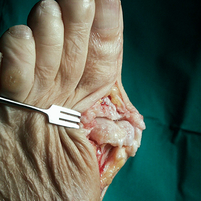 Hallux rigidus