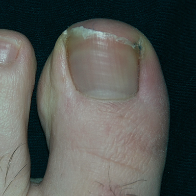 Ingrowing toenail