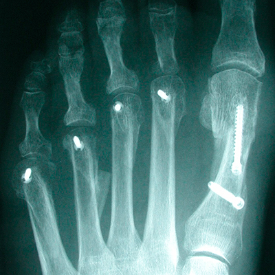 X-ray of lesser toe deformity