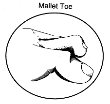 Mallet toe