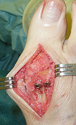 MTP joint fusion
