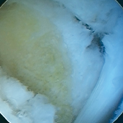 Posterior ankle scope