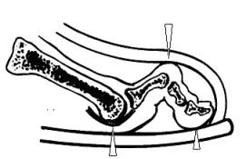 Hammer toe