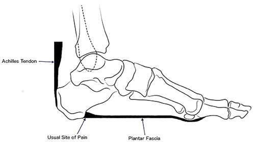 Heel Pain and Plantar Fasciitis