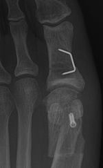 Osteotomy