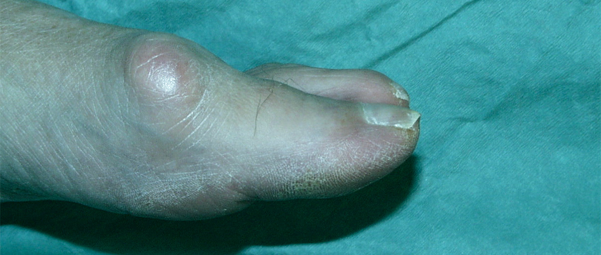 Hallux Rigidus or Arthritis of the Big Toe